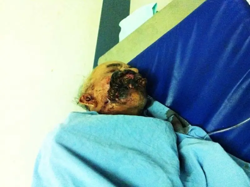 Idoso com câncer fica dois dias com larvas no rosto em hospital de AL