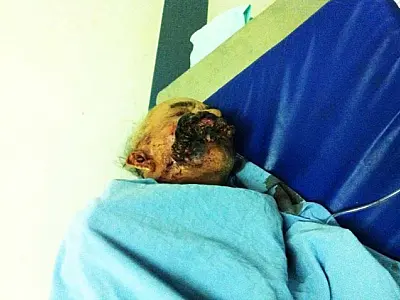 Idoso com câncer fica dois dias com larvas no rosto em hospital de AL