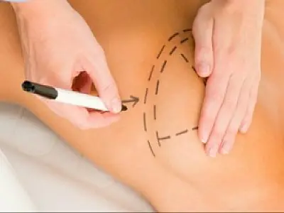 Após cirurgia de mama, 20% das mulheres precisam de uma segunda operação
