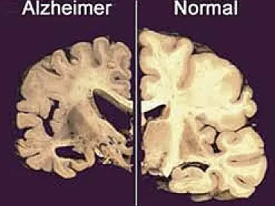 Cientistas descobrem 'elo perdido' e preveem cura do mal de Alzheimer