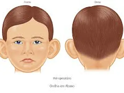 Proposta obriga SUS a realizar cirurgia reparadora nas orelhas