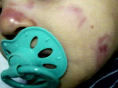 Bebê de um ano sofre ferimentos em creche de Nova Andradina