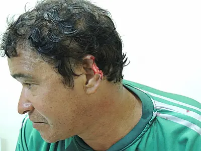 Filho morde e arranca pedaço da orelha do pai em MS