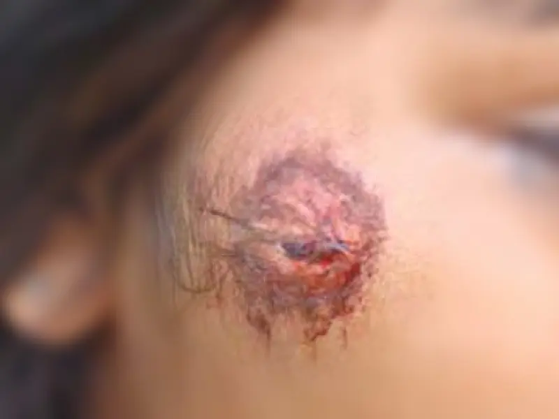 Menor é agredida e mordida pelo ex-companheiro