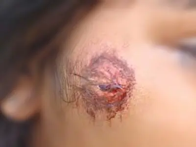 Menor é agredida e mordida pelo ex-companheiro