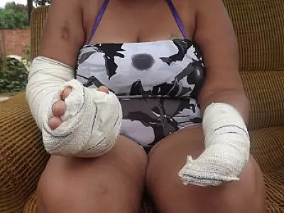 Jovem que teve mão amputada pelo ex recebe alta