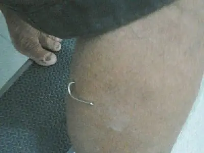 Pintor crava anzol na perna durante pescaria