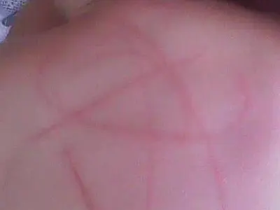 Mãe de bebê que teve as costas arranhada com sabonete desabafa no Facebook