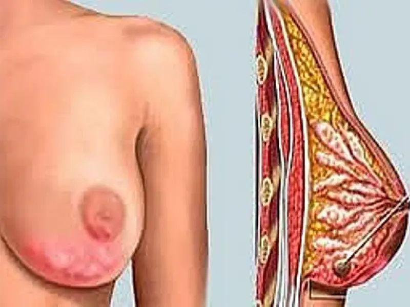 Novo medicamento contra câncer de mama pode prolongar vida