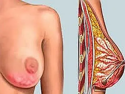 Novo medicamento contra câncer de mama pode prolongar vida