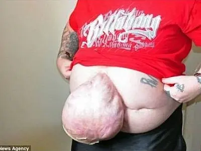 Homem luta para remover hérnia gigante no estômago