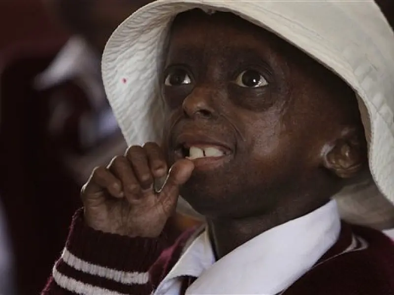 Menina africana sofre de envelhecimento precoce