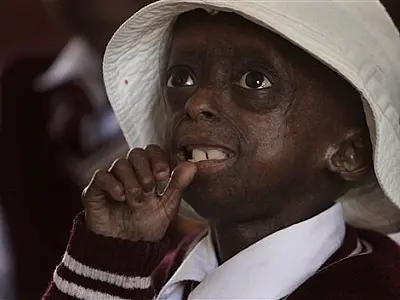 Menina africana sofre de envelhecimento precoce