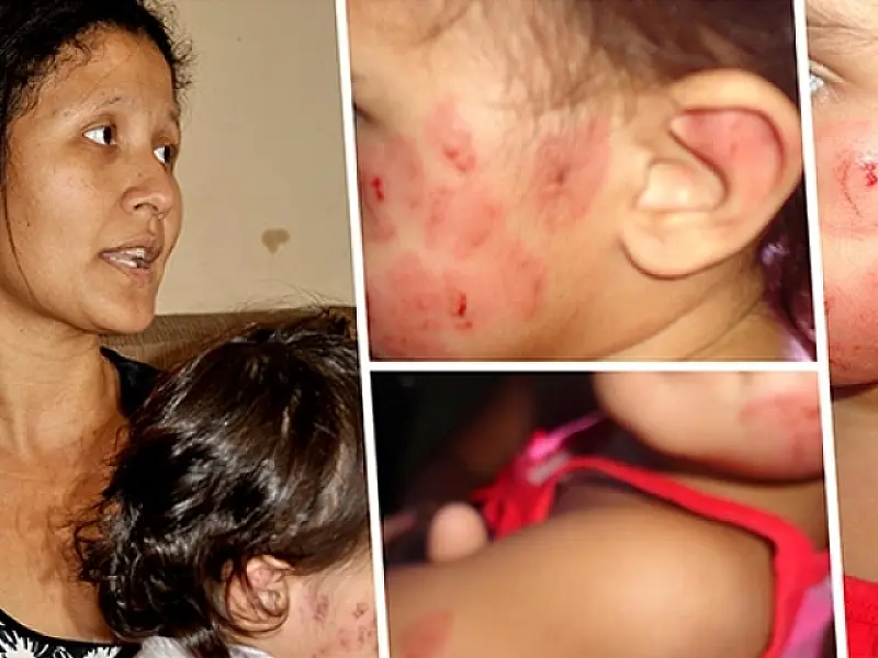 Educação começa a apurar caso de menina atacada a mordidas em creche
