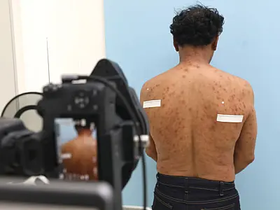 SES promove capacitação sobre talidomida para profissionais da saúde de MS