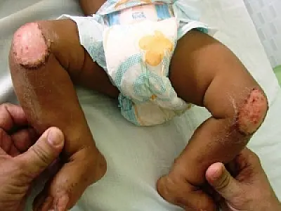 Mãe é acusada de queimar filho de seis meses em Ladário