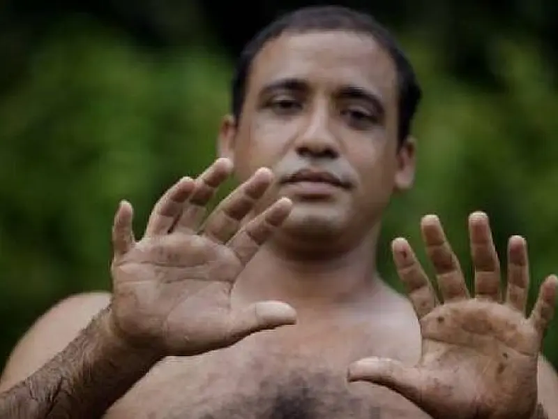 Cubano mostra orgulhoso mãos e pés com 6 dedos cada