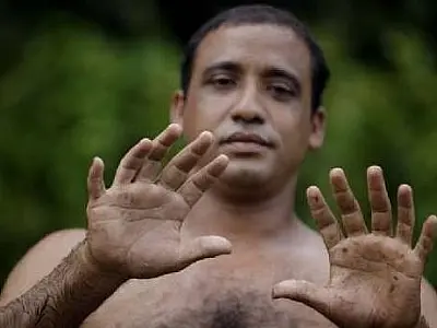 Cubano mostra orgulhoso mãos e pés com 6 dedos cada
