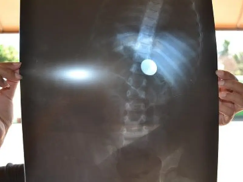 Criança de 2 anos engole moeda de cinco centavos em Sonora