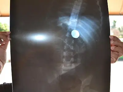 Criança de 2 anos engole moeda de cinco centavos em Sonora