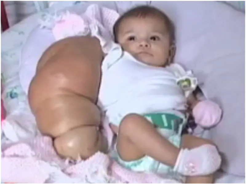Pais pedem doações para bebê que nasceu com braço gigante