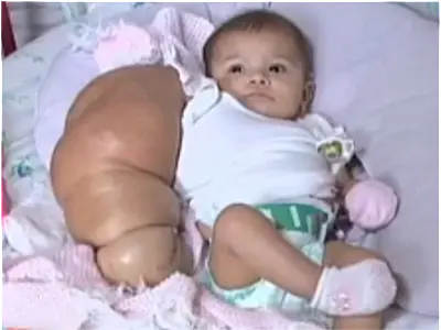 Pais pedem doações para bebê que nasceu com braço gigante