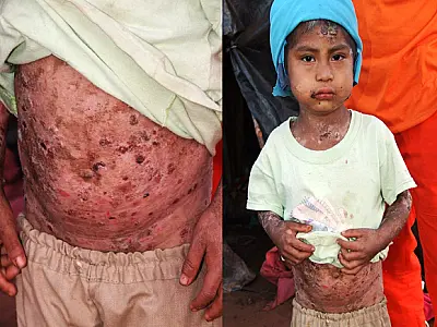 Menino de 4 anos sofre com doença dermatológica grave